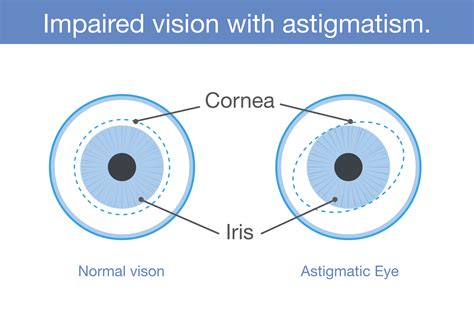 Astigmatism | The Canadian Association of Optometrists