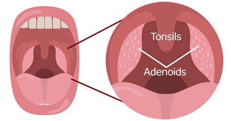 Birmingham Tonsils and Adenoids - Alabama Nasal and Sinus Center