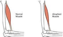 Muscle Atrophy: Causes, Symptoms & Treatments | New Health Advisor