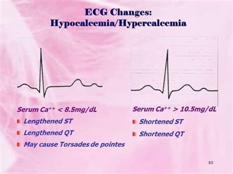 Hypercalcemia Ecg