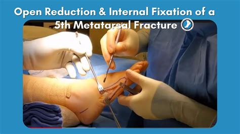 Open Reduction Internal Fixation Of A 5th Metatarsal, 53% OFF