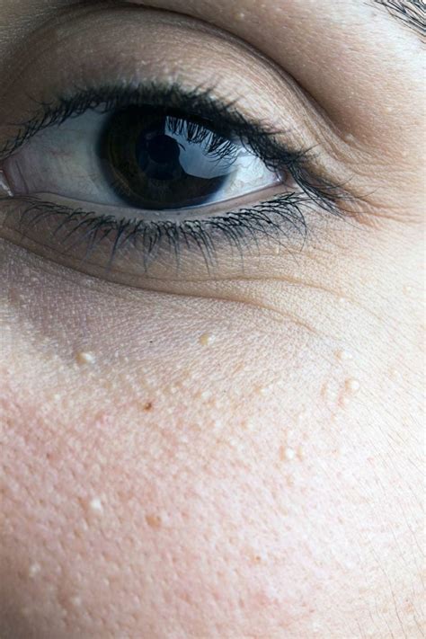 Milia under eyes: Causes, diagnosis, and treatment