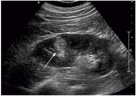 What Does A Kidney Tumor Look Like On An Ultrasound - Infoupdate.org