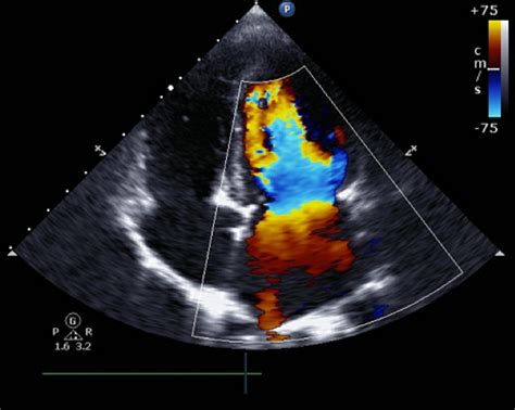 WHAT ARE THE DIFFERENT TYPES OF HEART ULTRASOUNDS?