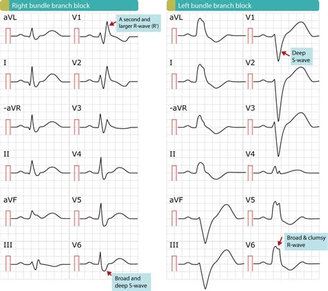 Right bundle branch block (RBBB): ECG, criteria, definitions, causes & management – ECG learning