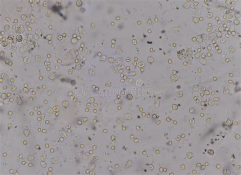 RBC WBC and Bacteria in Urine Stock Image - Image of medical, microscopy: 197034767