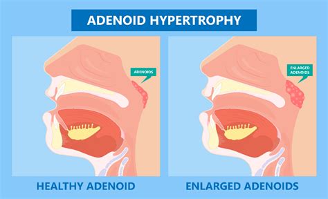 Adenoid Nose