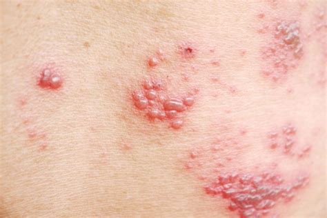 Benefits of the new shingles vaccine