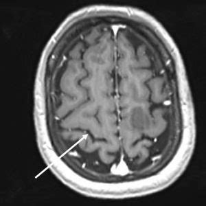 Central sulcus – Radiology Cases