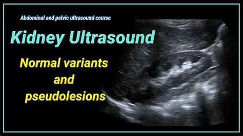 Normal Kidney Ultrasound