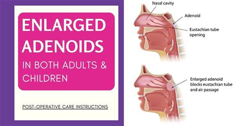 Pharyngeal Tonsils Location