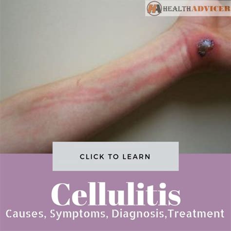 Cellulitis: Causes, Picture, Symptoms, Diagnosis And Treatment