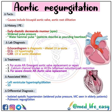 Aortic regurgitation flash card – Artofit