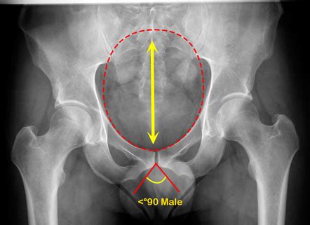 Male Vs Female Pelvis X Ray