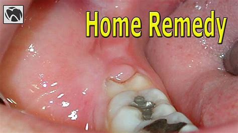 Tooth Infection Treatment At Home | Review Home Co