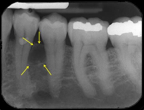 Radicular Cyst Symptoms, Causes, Radiology, Treatment