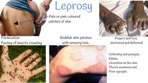 Leprosy - Midwives Revision