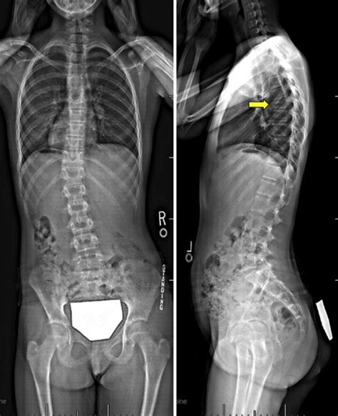 Standing spinal X-rays shows a compression fracture of T7 vertebral... | Download Scientific Diagram