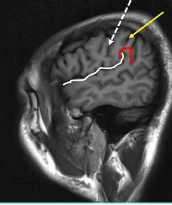 Central sulcus – Radiology Cases