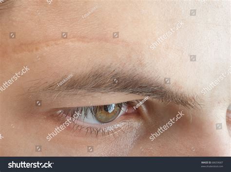 Scar On Forehead Stock Photo 68659687 : Shutterstock