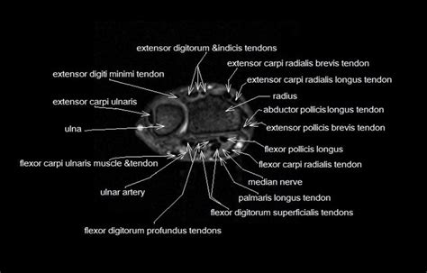 Wrist Ligament Anatomy Mri