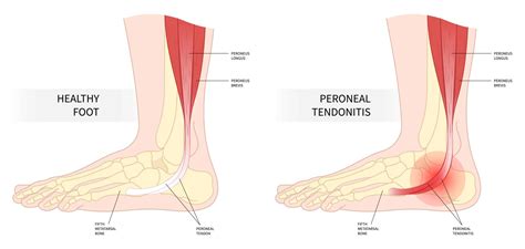 Tendonitis On The Side Of The Foot Online | emergencydentistry.com