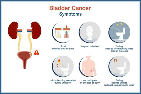 medical vector illustration infographic bladder cancer, bladder cancer symptoms In flat style ...