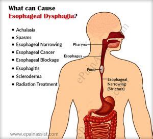 Dysphagia Surgery: Steps, Benefits, Side-Effects, Precautions & Prognosis - Best General ...