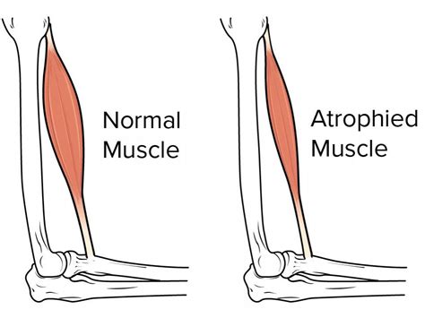 Muscle Atrophy: Causes, Symptoms & More | Total Orthocare