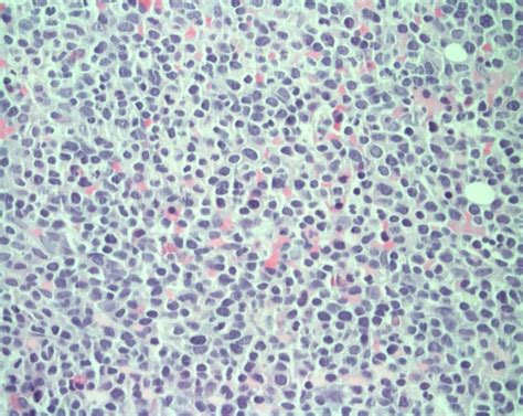 Bone marrow biopsy showing blast cells, consistent with acute leukemia ...