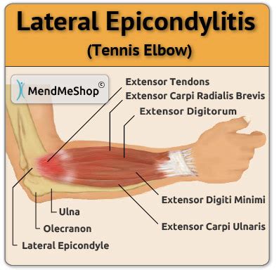 Causes of Tennis Elbow