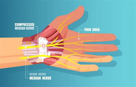 How do you get a Wrist Ligament Tear? | USA Spine Care & Orthopedics