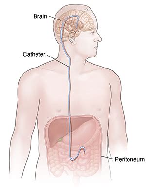 Having a Ventriculoperitoneal Shunt | Saint Luke's Health System