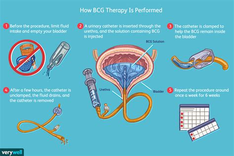 BCG Treatment for Bladder Cancer: What You Need to Know