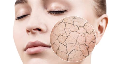 5 Signs You Have Dehydrated Skin! (+ How To Fix It!)