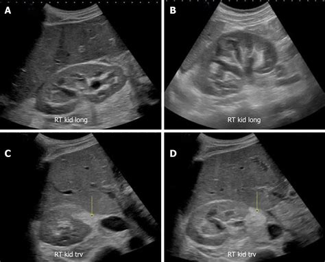 Damaged Kidney Ultrasound