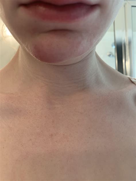 [Skin Concern] The right side of my chin is what it normally looks like. The left is swollen to ...