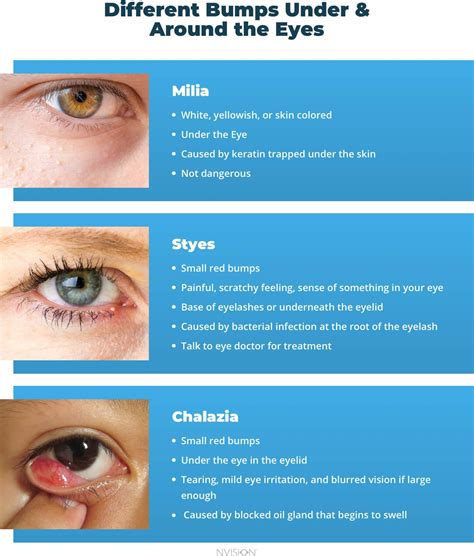 Bumps Under the Eyes: Types & How to Treat Them – NVISION