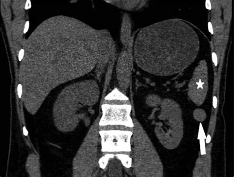 Coronal CT scan of accessory spleen below spleen level. Accessory... | Download Scientific Diagram