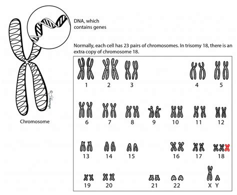 Trisomy 18 – Ohio Fetal Medicine Collaborative