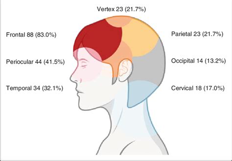 Topography of the headache. Number of patients that described pain in ...