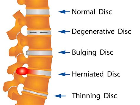 Bulging Disc | Novus Spine & Pain in Lakeland, Florida