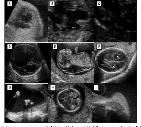 [PDF] Ultrasound in Trisomy 18 and 13 | Semantic Scholar