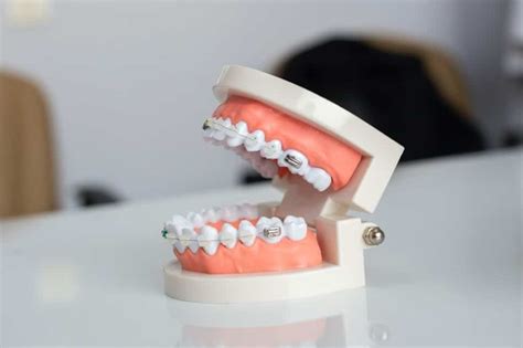 Broken Braces Bracket? How a Round Rock Orthodontist Can Help