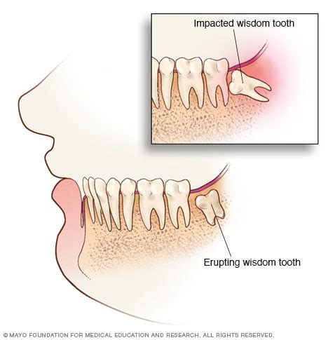 Impacted wisdom teeth - Symptoms and causes - Mayo Clinic