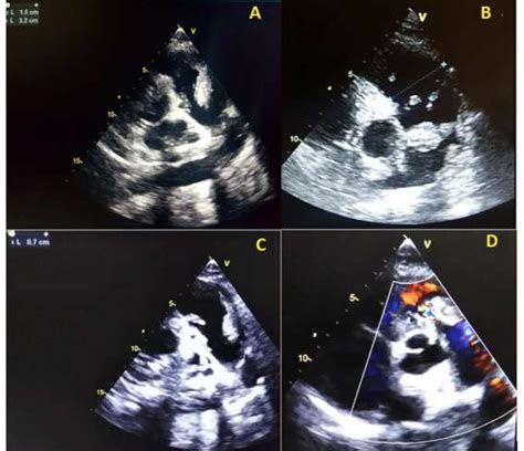 transthoracic echocardiography showing (A) large highly mobile pulmonic... | Download Scientific ...