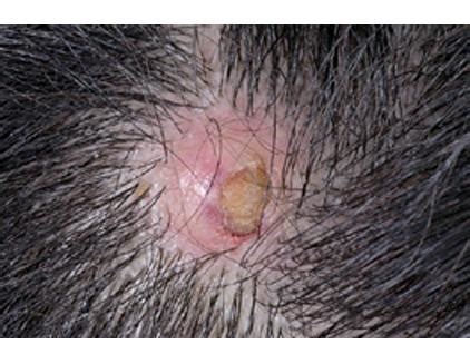 Medical Pictures Info – Pilar Cyst