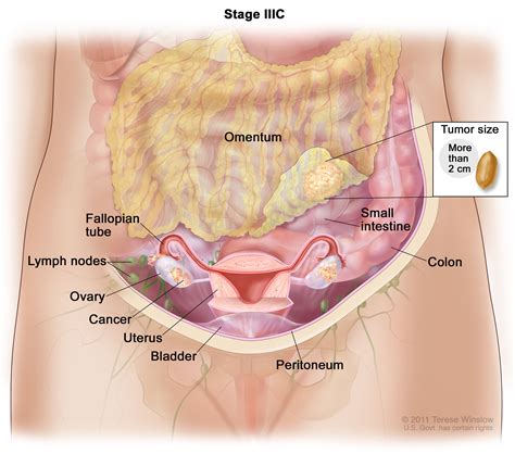 Treatment of Ovarian Epithelial, Fallopian, & Peritoneal Cancers - NCI