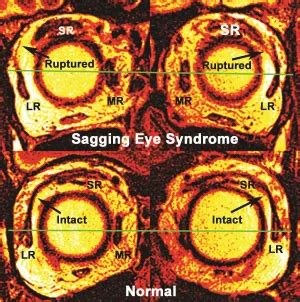 Sagging eye syndrome - American Academy of Ophthalmology