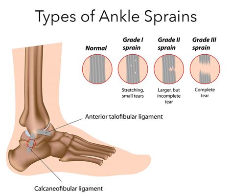 Ankle Sprain | Symptoms, Treatment, & Recovery Time